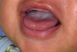 White Spots In Babys Mouth 95