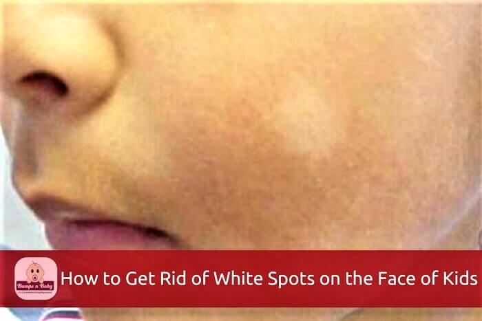 How to Get Rid of White Spots on the Face of Babies and Kids?